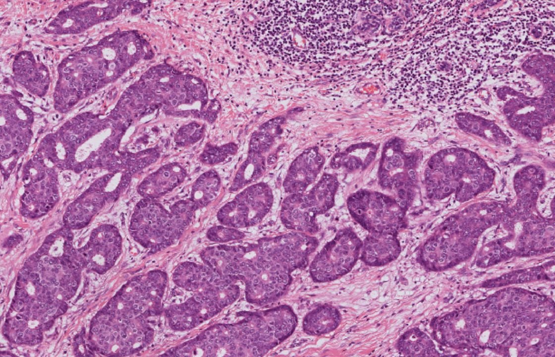 High-magnification H&E breast tumor slide showing tumor nests, nuclei, stroma and inflammatory areas